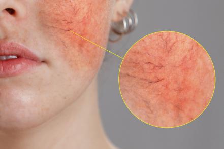 Rosacea rozacea