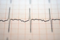 EKG-vizsgálat, szívbetegség EKG-vizsgálat, szívbetegség