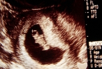 foetus in foeto, ikertestvér foetus in foeto, ikertestvér