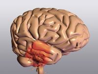 Parkinson-kór, génterápia Parkinson-kór, génterápia