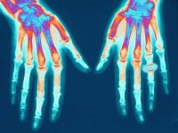 ízületi gyulladás, rheumatoid arthritis, fehérje ízületi gyulladás, rheumatoid arthritis, fehérje