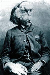 Joseph Merrick