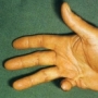 ínzsugor Dupuytren contractura ínzsugor Dupuytren contractura